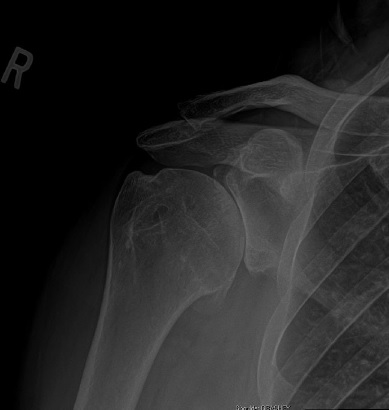 WHAT IS SHOULDER ARTHRITIS